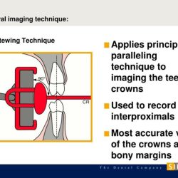 Basic principles of the bitewing technique include the: